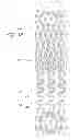 Fig. 18 - Method of treating vascular bifurcations