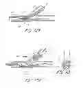 Fig. 27 - Method of treating vascular bifurcations