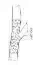 Fig. 30 - Method of treating vascular bifurcations