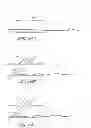 Fig. 31 - Method of treating vascular bifurcations