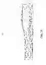 Fig. 44 - Method of treating vascular bifurcations