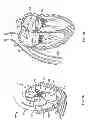 Fig. 02 - Methods, systems and devices for cardiac valve repair
