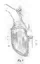 Fig. 02 - Reinforced distributor for post-combustion lance