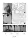 Fig. 03 - NEOPLASTIC CELLS GROWN ON DECELLULARIZED BIOMATRIX