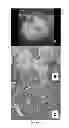Fig. 06 - NEOPLASTIC CELLS GROWN ON DECELLULARIZED BIOMATRIX