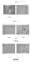 Fig. 14 - NEOPLASTIC CELLS GROWN ON DECELLULARIZED BIOMATRIX