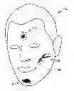 Fig. 01 - Prosthetic appliance transfer kit and method