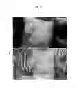 Fig. 04 - Methods and compositions for treating a subject for a lymphatic malformation