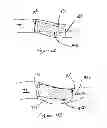 Fig. 04 - Methods for recanalization of vessels