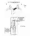 Fig. 05 - Methods for recanalization of vessels