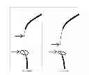 Fig. 10 - Methods for recanalization of vessels