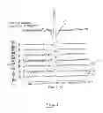 Fig. 02 - Method and device positioning a linear array of electrodes in a patient's respiratory airways
