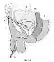 Fig. 06 - CATHETERS