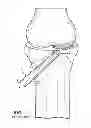 Fig. 02 - Bone tamp apparatus and method