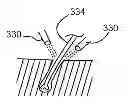 Fig. 01 - Hair Removal Devices and Methods