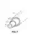 Fig. 08 - Endometrial ablation method