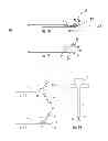 Fig. 05 - K-wire and method for surgical procedures
