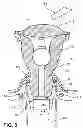 Fig. 13 - Uterine manipulator assemblies and related components and methods