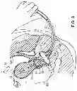 Fig. 14 - Uterine manipulator assemblies and related components and methods