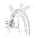 Fig. 01 - Aortic valve repair