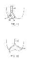 Fig. 07 - Aortic valve repair