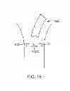 Fig. 09 - Aortic valve repair