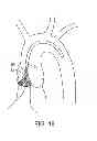 Fig. 11 - Aortic valve repair