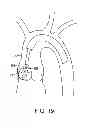 Fig. 12 - Aortic valve repair