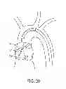 Fig. 13 - Aortic valve repair