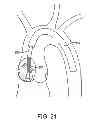 Fig. 14 - Aortic valve repair