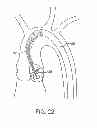 Fig. 15 - Aortic valve repair