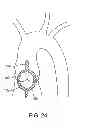 Fig. 17 - Aortic valve repair