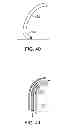 Fig. 25 - Aortic valve repair