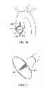 Fig. 28 - Aortic valve repair