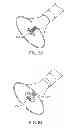 Fig. 31 - Aortic valve repair