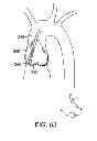 Fig. 36 - Aortic valve repair