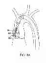 Fig. 37 - Aortic valve repair