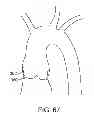 Fig. 39 - Aortic valve repair