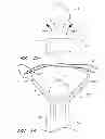 Fig. 04 - Suture passer systems and methods for palate suspension and compression