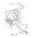 Fig. 21 - Suture passer systems and methods for palate suspension and compression