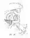 Fig. 22 - Suture passer systems and methods for palate suspension and compression