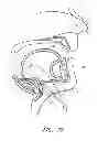 Fig. 25 - Suture passer systems and methods for palate suspension and compression