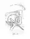 Fig. 27 - Suture passer systems and methods for palate suspension and compression