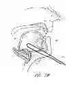 Fig. 28 - Suture passer systems and methods for palate suspension and compression