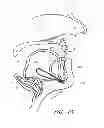Fig. 29 - Suture passer systems and methods for palate suspension and compression