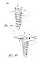 Fig. 36 - Suture passer systems and methods for palate suspension and compression