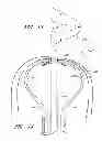 Fig. 43 - Suture passer systems and methods for palate suspension and compression