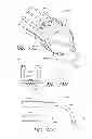 Fig. 44 - Suture passer systems and methods for palate suspension and compression
