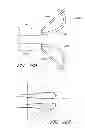 Fig. 45 - Suture passer systems and methods for palate suspension and compression