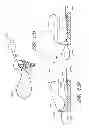 Fig. 52 - Suture passer systems and methods for palate suspension and compression